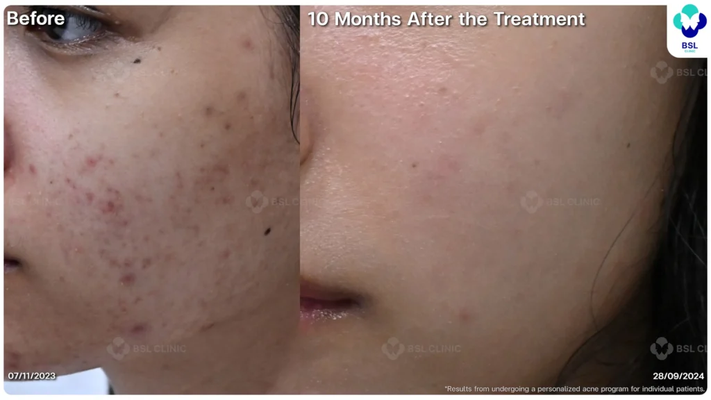 รีวิว ก่อนและหลัง โปรแกรมรักษาสิว รอยสิว หลุมสิว