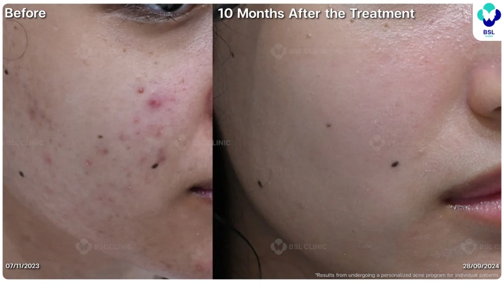 รีวิว ก่อนและหลัง โปรแกรมรักษาสิว รอยสิว หลุมสิว