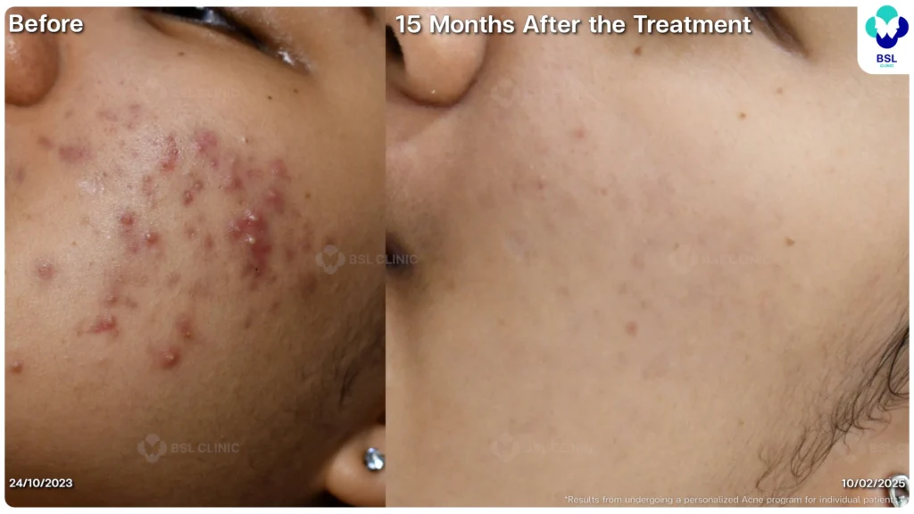 รีวิว ก่อนและหลัง โปรแกรมรักษาสิว รอยสิว หลุมสิว