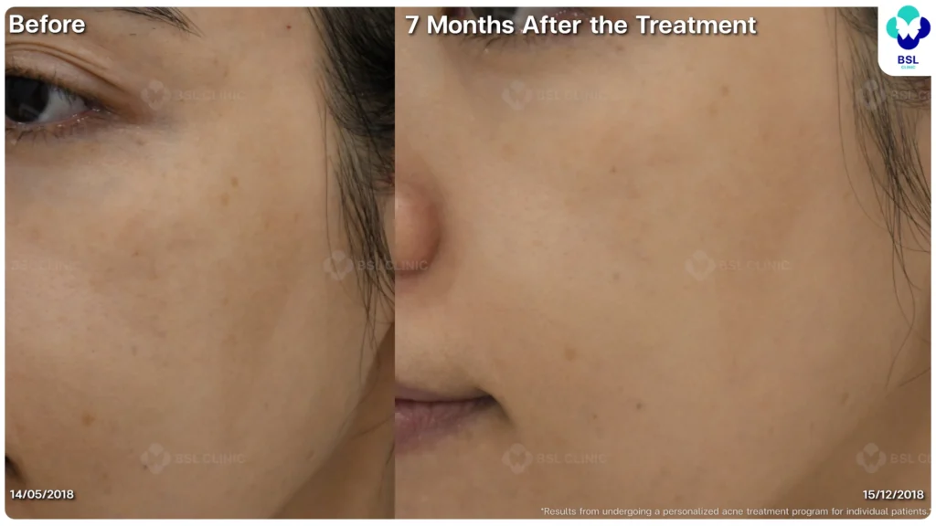 รีวิว ก่อนและหลัง โปรแกรมรักษาสิว รอยสิว หลุมสิว