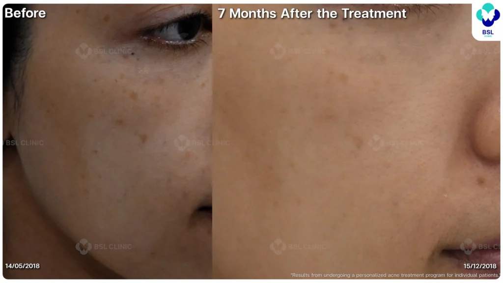 รีวิว ก่อนและหลัง โปรแกรมรักษาสิว รอยสิว หลุมสิว