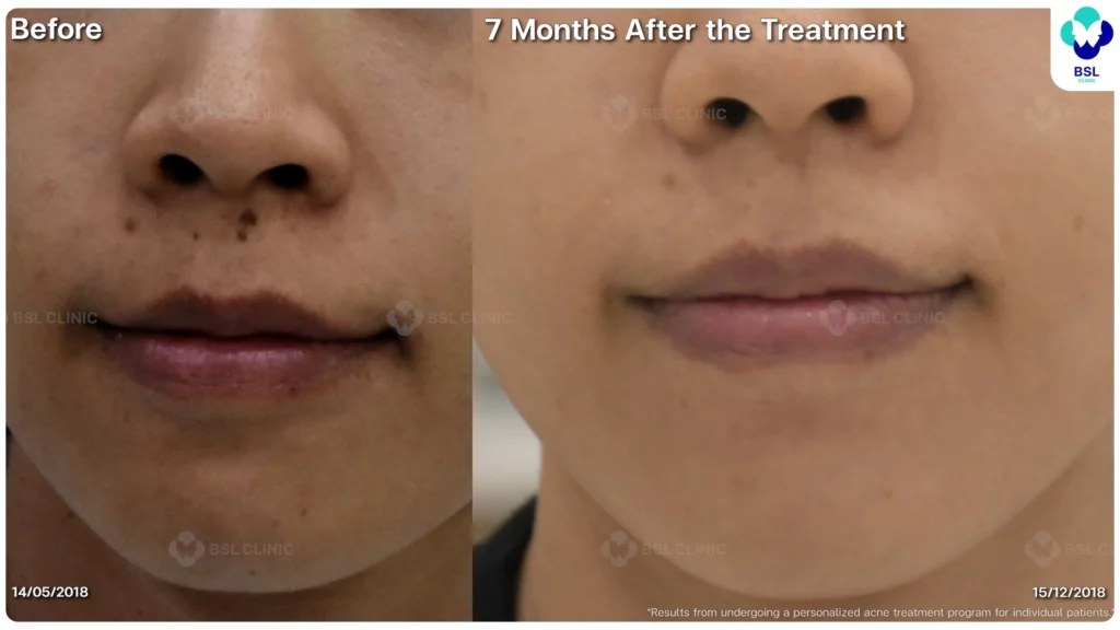 รีวิว ก่อนและหลัง โปรแกรมรักษาสิว รอยสิว หลุมสิว