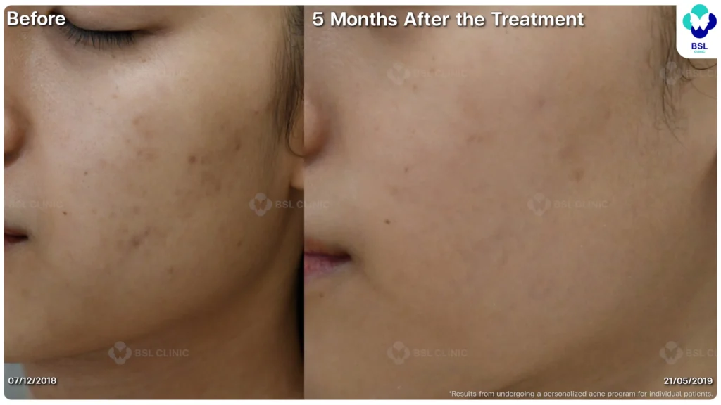 รีวิว ก่อนและหลัง โปรแกรมรักษาสิว รอยสิว หลุมสิว