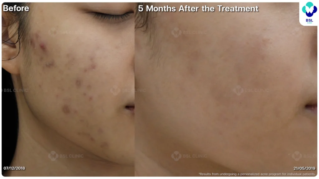 รีวิว ก่อนและหลัง โปรแกรมรักษาสิว รอยสิว หลุมสิว