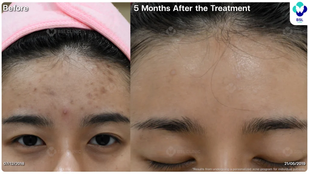 รีวิว ก่อนและหลัง โปรแกรมรักษาสิว รอยสิว หลุมสิว