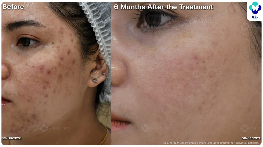 รีวิว ก่อนและหลัง โปรแกรมรักษาสิว รอยสิว หลุมสิว