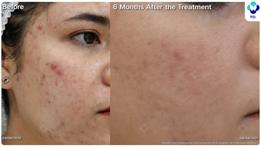 รีวิว ก่อนและหลัง โปรแกรมรักษาสิว รอยสิว หลุมสิว