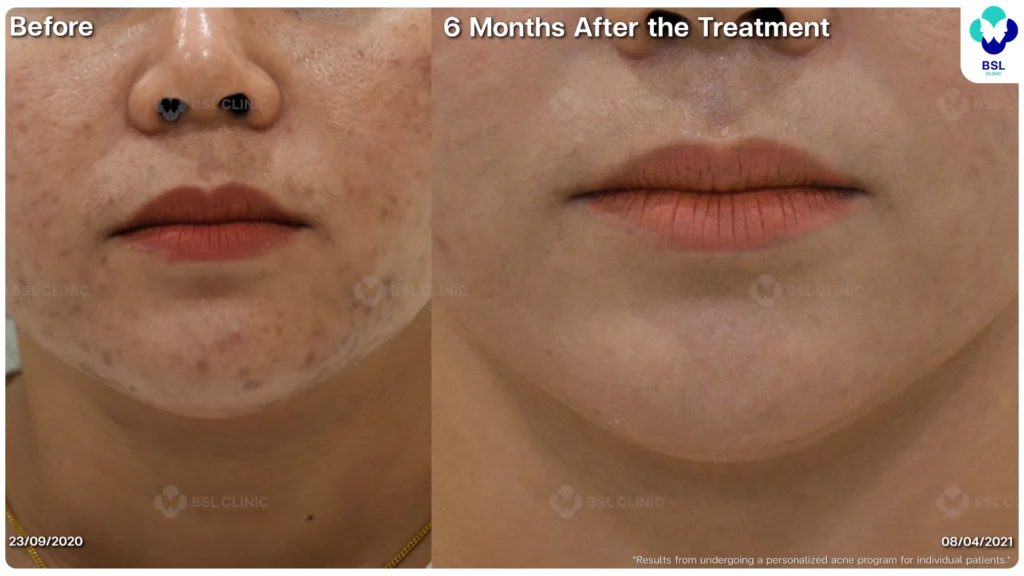 รีวิว ก่อนและหลัง โปรแกรมรักษาสิว รอยสิว หลุมสิว