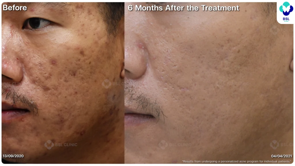 รีวิว ก่อนและหลัง โปรแกรมรักษาสิว รอยสิว หลุมสิว