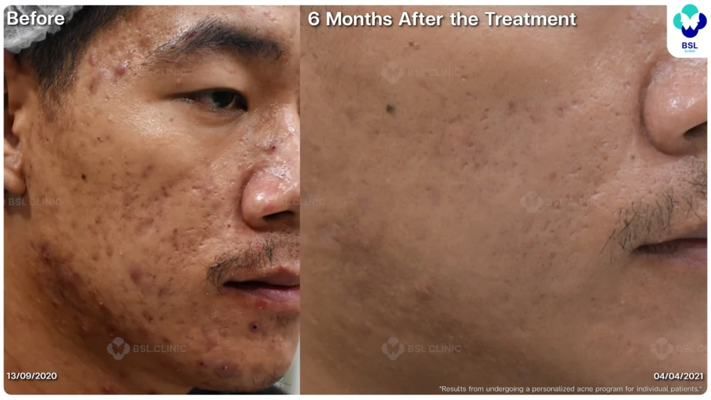 รีวิว ก่อนและหลัง โปรแกรมรักษาสิว รอยสิว หลุมสิว