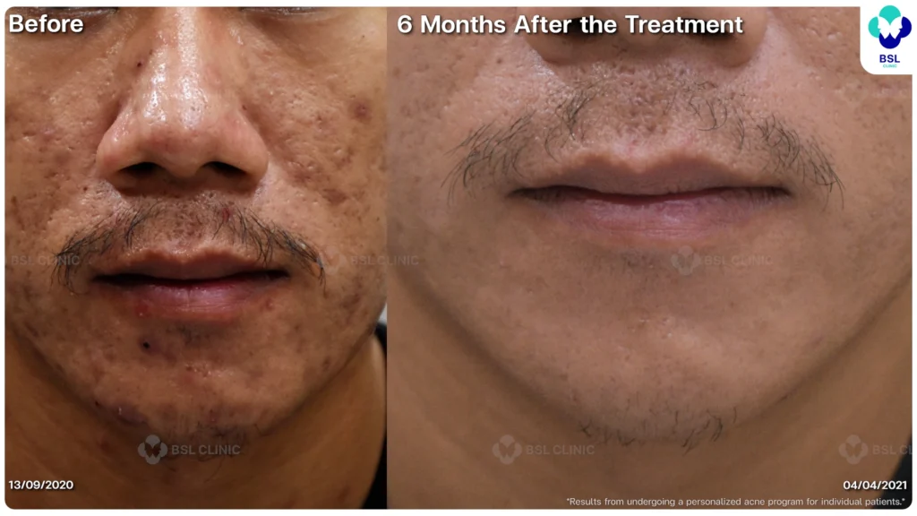 รีวิว ก่อนและหลัง โปรแกรมรักษาสิว รอยสิว หลุมสิว