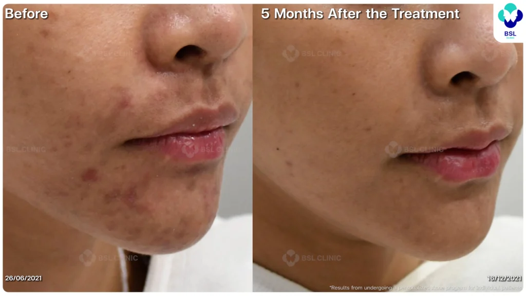 รีวิว ก่อนและหลัง โปรแกรมรักษาสิว รอยสิว หลุมสิว