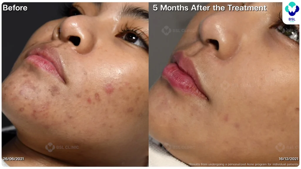 รีวิว ก่อนและหลัง โปรแกรมรักษาสิว รอยสิว หลุมสิว