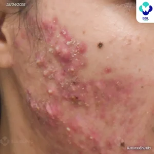 สิวหัวช้าง ก้อนลึก (Nodule)