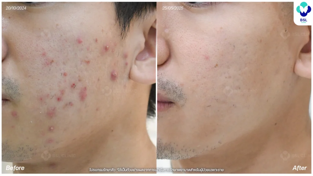 รีวิวเลเซอร์รอยแดงสิว-เห็นผลไหม-BA-เลเซอร์สิว