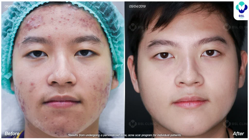 รีวิว ก่อนและหลัง โปรแกรมรักษาสิว รอยสิว หลุมสิว