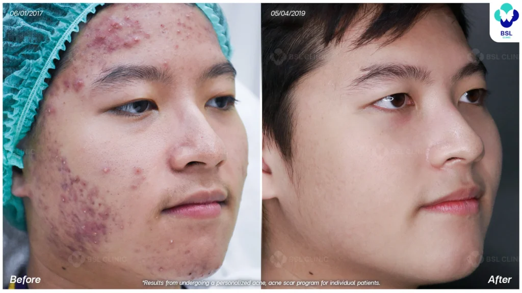 รีวิว ก่อนและหลัง โปรแกรมรักษาสิว รอยสิว หลุมสิว