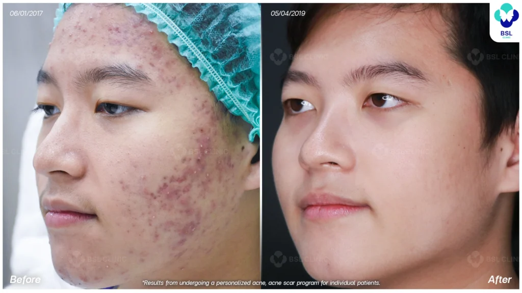 รีวิว ก่อนและหลัง โปรแกรมรักษาสิว รอยสิว หลุมสิว