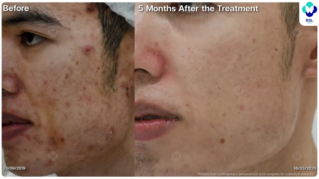 รีวิว ก่อนและหลัง โปรแกรมรักษาสิว รอยสิว หลุมสิว