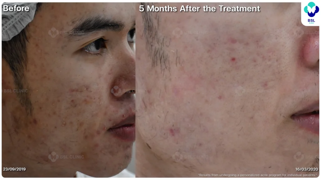 รีวิว ก่อนและหลัง โปรแกรมรักษาสิว รอยสิว หลุมสิว