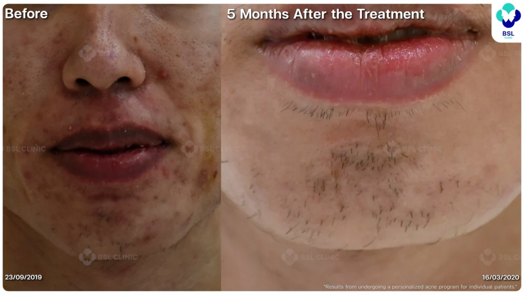 รีวิว ก่อนและหลัง โปรแกรมรักษาสิว รอยสิว หลุมสิว