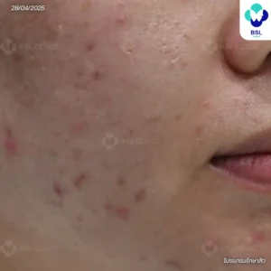 สิวอักเสบตุ่มแดง (Papule) 