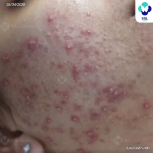 สิวอักเสบหัวหนอง (Pustule)