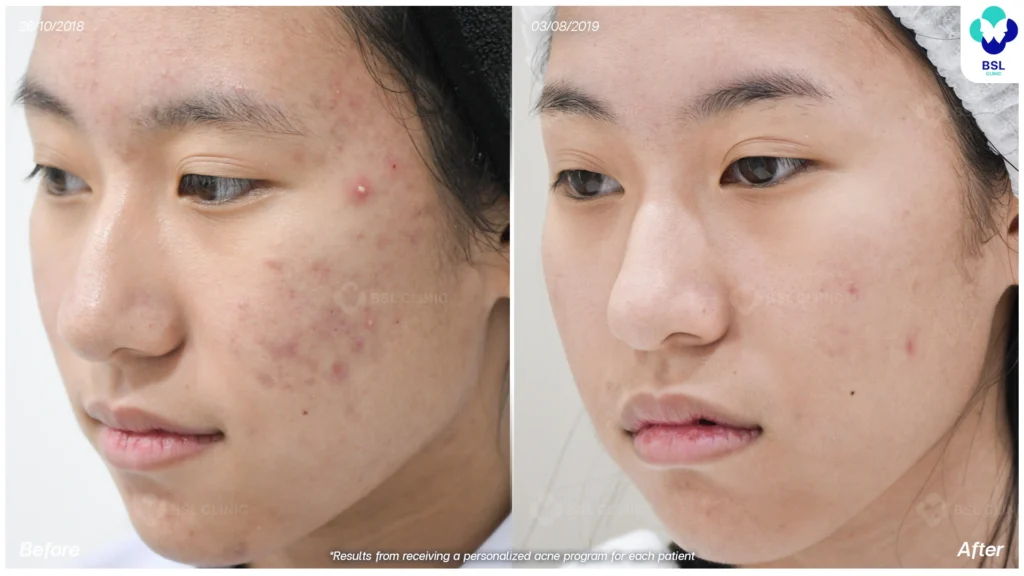 รีวิว ก่อนและหลัง โปรแกรมรักษาสิว รอยสิว หลุมสิว