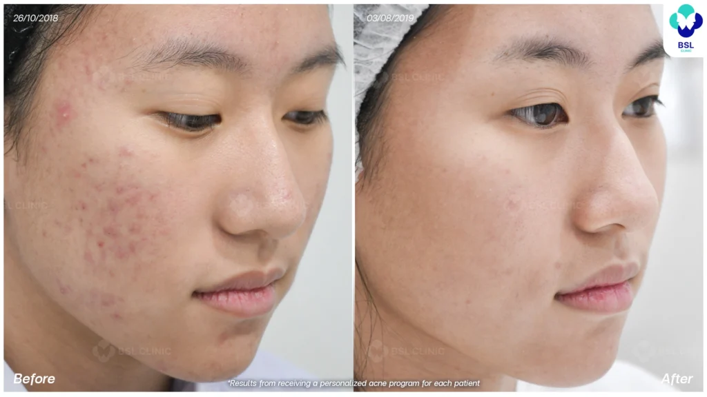 รีวิว ก่อนและหลัง โปรแกรมรักษาสิว รอยสิว หลุมสิว