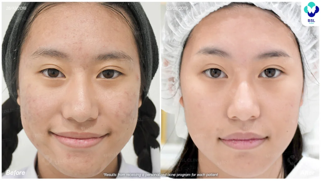 รีวิว ก่อนและหลัง โปรแกรมรักษาสิว รอยสิว หลุมสิว