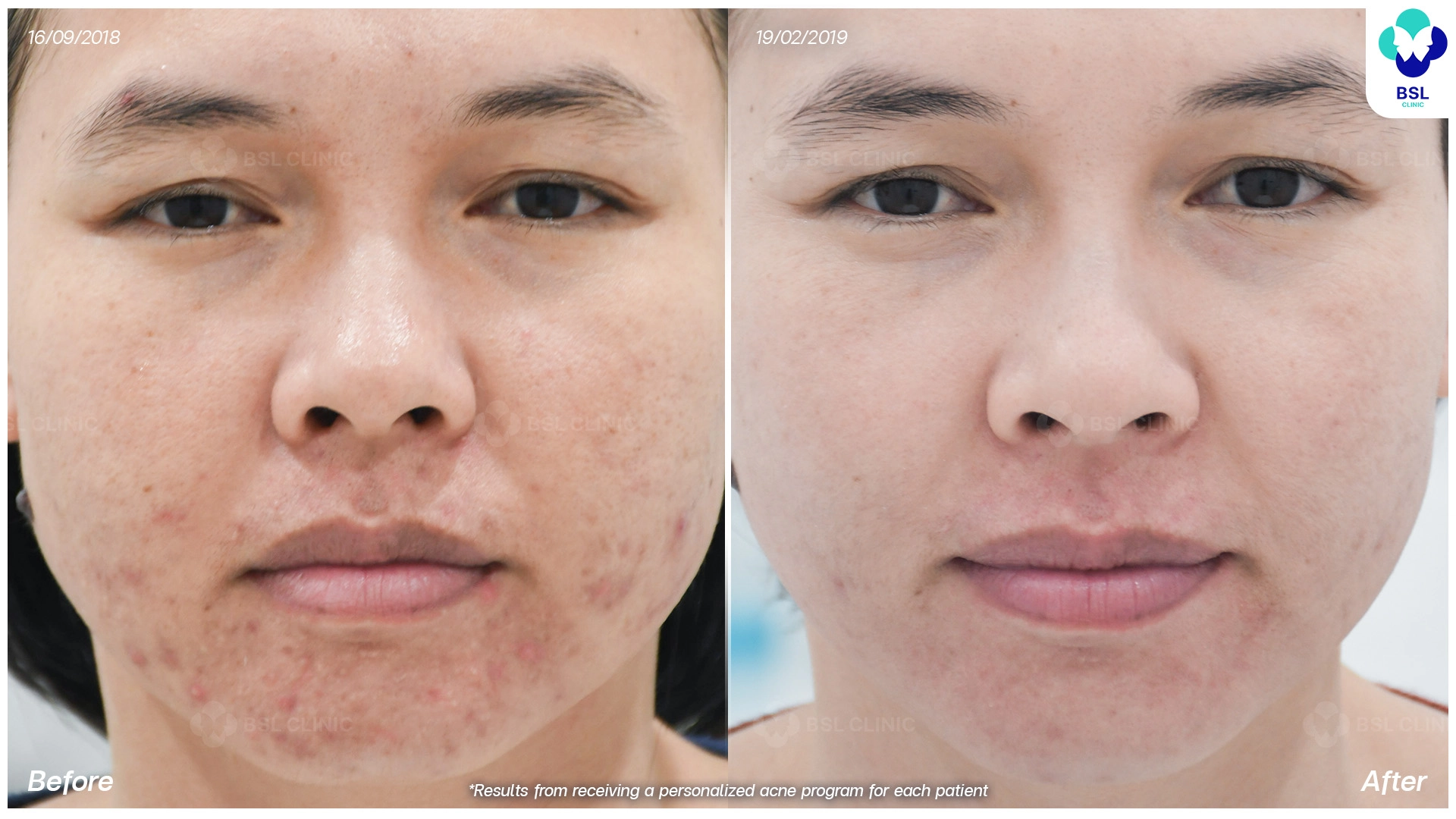 รีวิวเลเซอร์รอยแดงสิว-เห็นผลไหม-BA-เลเซอร์สิว
