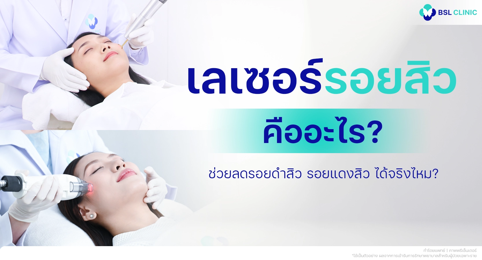 เลเซอร์รอยสิว คืออะไร ช่วยลดรอยดำสิว รอยแดงสิว และฟื้นฟูผิวหน้าได้อย่างไร
