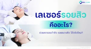 เลเซอร์รอยสิว คืออะไร ? ช่วยลดรอยดำสิว รอยแดงสิว ได้จริงไหม?