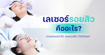 เลเซอร์รอยสิว คืออะไร ? ช่วยลดรอยดำสิว รอยแดงสิว ได้จริงไหม?