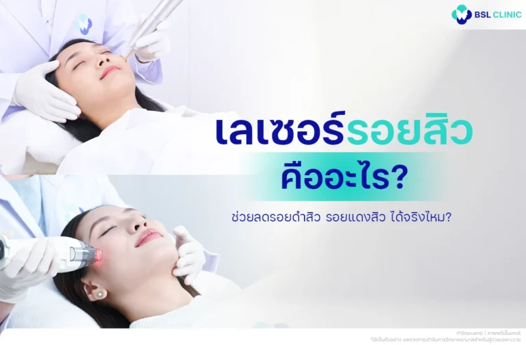 เลเซอร์รอยสิว คืออะไร ? ช่วยลดรอยดำสิว รอยแดงสิว ได้จริงไหม?
