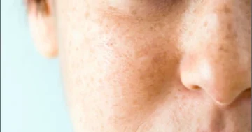 Melasma Treatment
