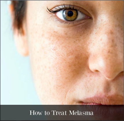 Melasma Treatment