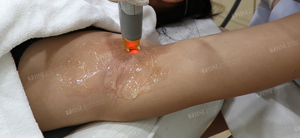 Long-Term Hair Reduction by BSL Clinic