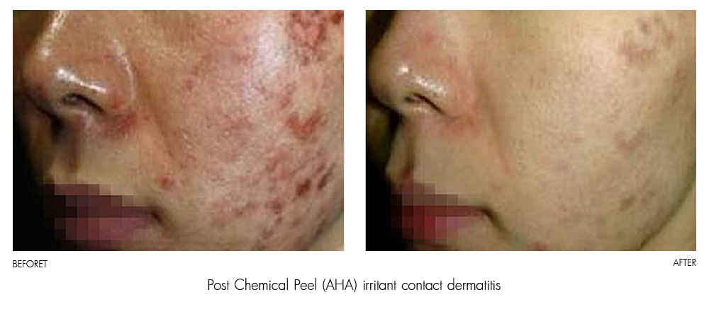 result Therapy Healite II