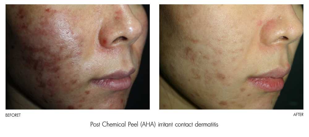 result Therapy Healite II