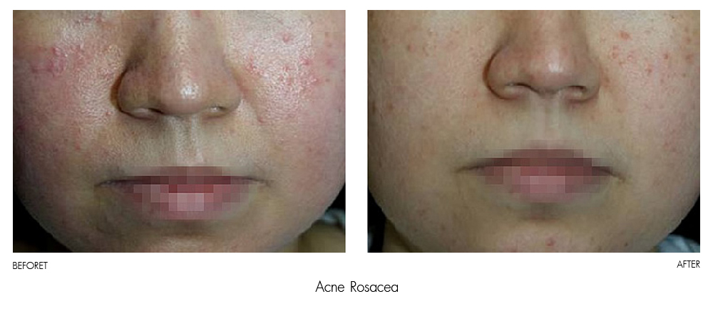 result Therapy Healite II