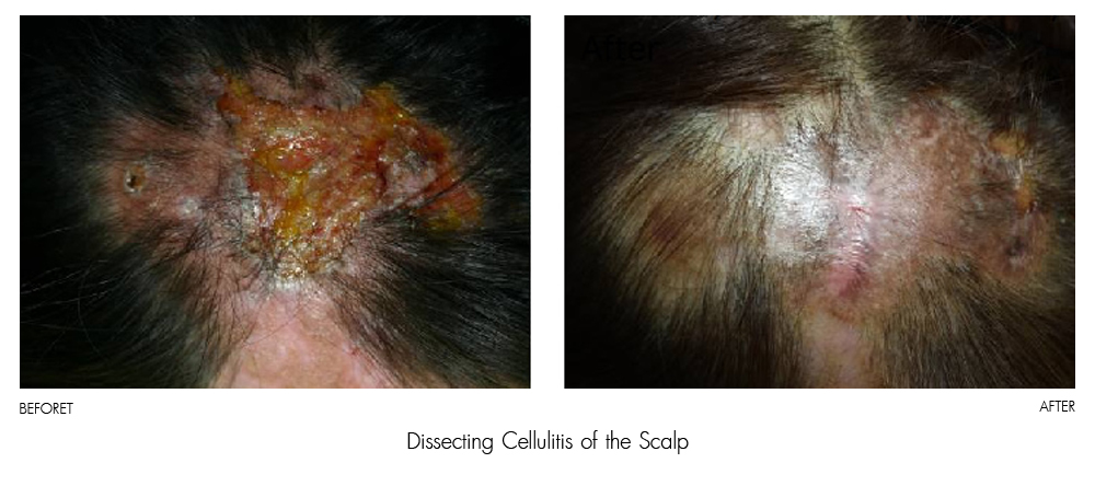 result Therapy Healite II