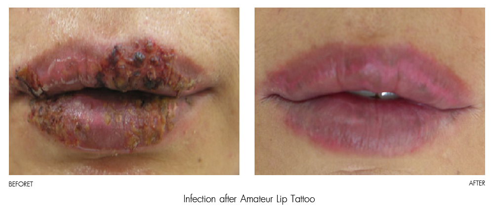 result Therapy Healite II