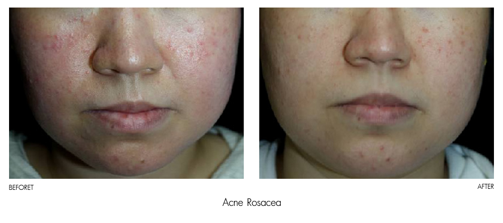 result Therapy Healite II