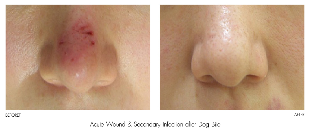 result Therapy Healite II