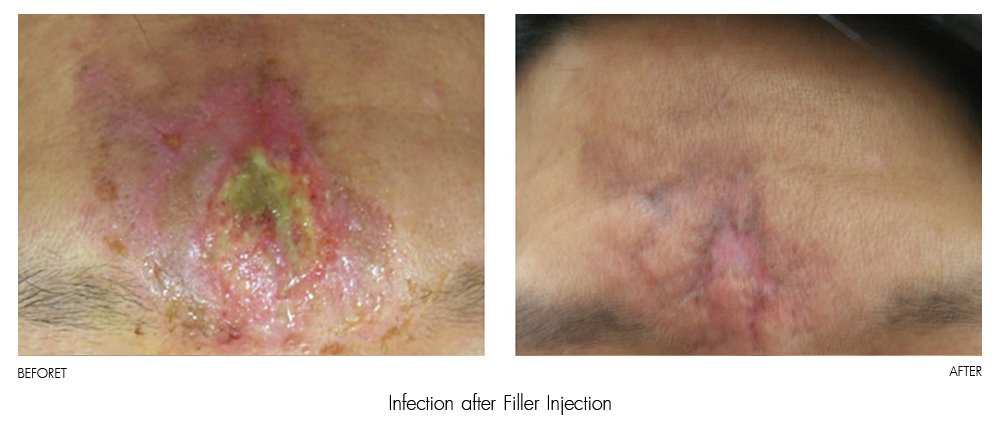 result Therapy Healite II