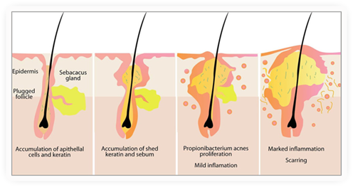 Major Causes of Acne
