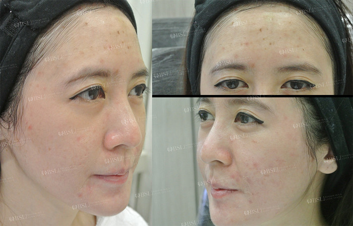 Before Treatment