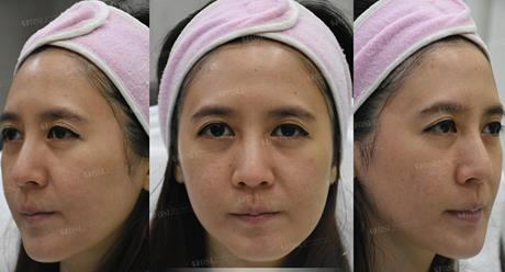 After Treatment