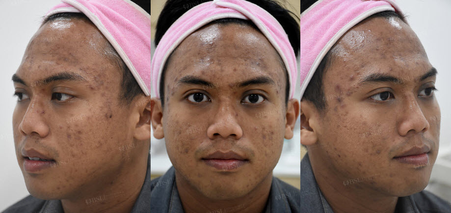 BSL Clinic's Signature Acne Treatment